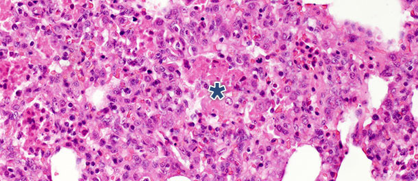 Интраальвеолярный некротический дебрис и аккумуляция воспалительных клеток (звездочка) в тканях легкого через 10 дней ПИ изолятом вируса РРСС типа 1, подтип 1.