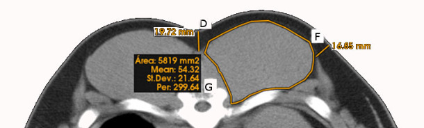 Linear, curvilinear and area measurements obtained on CT scans of the loin area (D = Top subcutaneous fat layer thickness, F = Lateral subcutaneous fat layer thickness, G = Loin area and perimeter.)