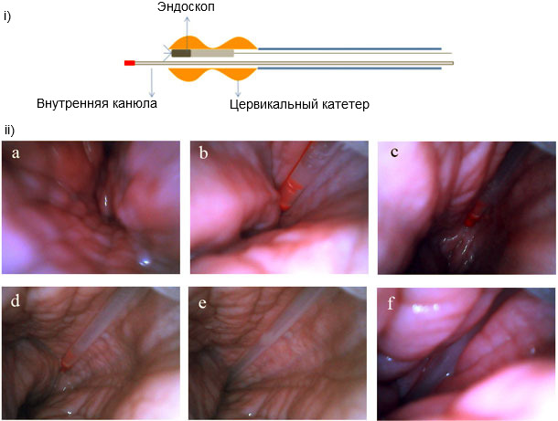 Post-cervical insemination seen from inside the uterus