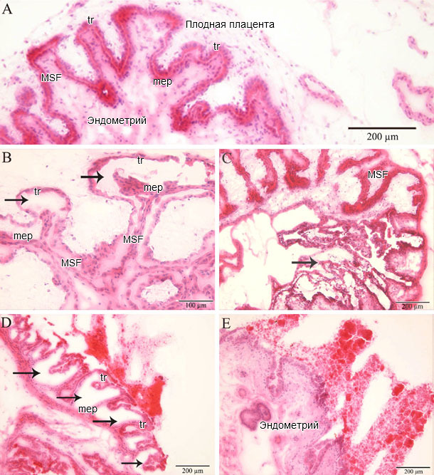 Гистопатология в эндометрии и плаценте