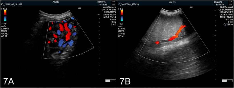 Рис. 7: Изображения яичка, полученные с использованием ультрасонографии в режиме цветового доплера. A) Сосуды семенного канала. B) Яичковая артерия.
