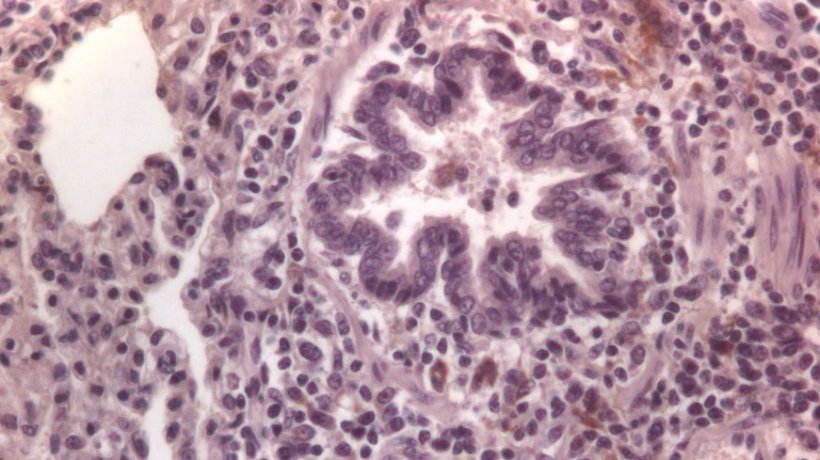 Фото 3: Иммунноотмеченные для ЦВС-2 клетки легких
