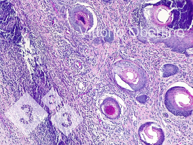 Фото 8. Пупок. Локально распространенная дермальная зона, состоящая из фиброплазии с активированными фибробластами и многочисленными незрелыми мелкими сосудами (новообразованная грануляционная ткань), мультифокальный воспалительный инфильтрат с преобладанием лимфоплазматических клеток; в некоторых сосудистых структурах имеется воспалительный гранулоцитарный инфильтрат, окружающий стенку сосуда и очагово инфильтрирующий ее (лейкоцитокластический васкулит).
