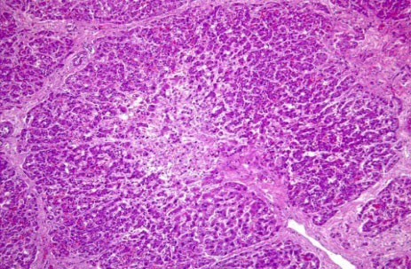 Центро-лобулярный некроз гепатоцита  и обширное разрушение структуры печени мононуклеарным воспалением, а также мегалоциты.