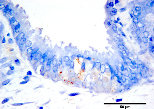 Иммуногистохимическое окрашивание антигена ЦВС-2б в коричневый цвет в омертвевших трофобластах. Конрастирование диаминобензидин - хромогеном и гематоксилином.